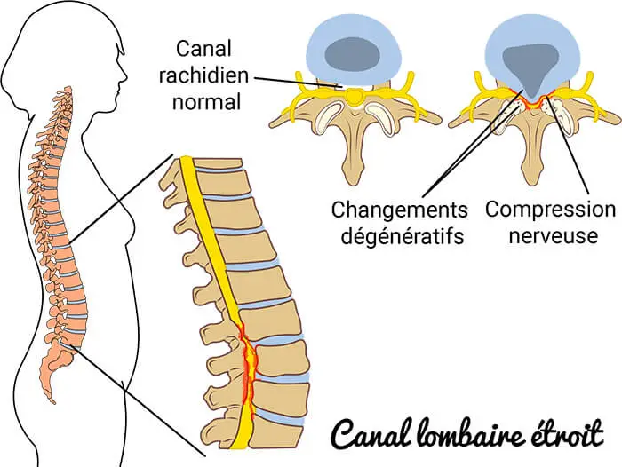 Canal lombaire étroit